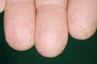 海綿状皮膚炎はどのように治療されますか?