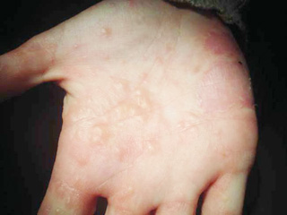 様 炎 かぶれ 砂 皮膚 砂かぶれ様皮膚炎、最近流行ってる？