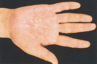 様 砂 皮膚 炎 かぶれ 子供の手のぶつぶつが痒い！砂かぶれ様皮膚炎はかなり手強い！【画像あり】