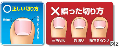 陥入爪 広島市南区段原日出の皮膚科 アレルギー科 しんどう皮ふ科アレルギー科